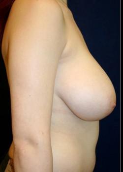 Breast Reduction before at Tanasbourne Plastic Surgery: Cober Sheldon R MD in Portland, OR