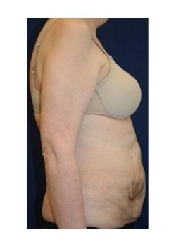 Liposuction before at Tanasbourne Plastic Surgery: Cober Sheldon R MD in Portland, OR