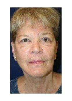 Tanasbourne Plastic Surgery: Cober Sheldon R MD facelift after — Portland, OR