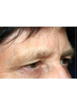 Brow Lift before at Tanasbourne Plastic Surgery: Cober Sheldon R MD in Portland, OR