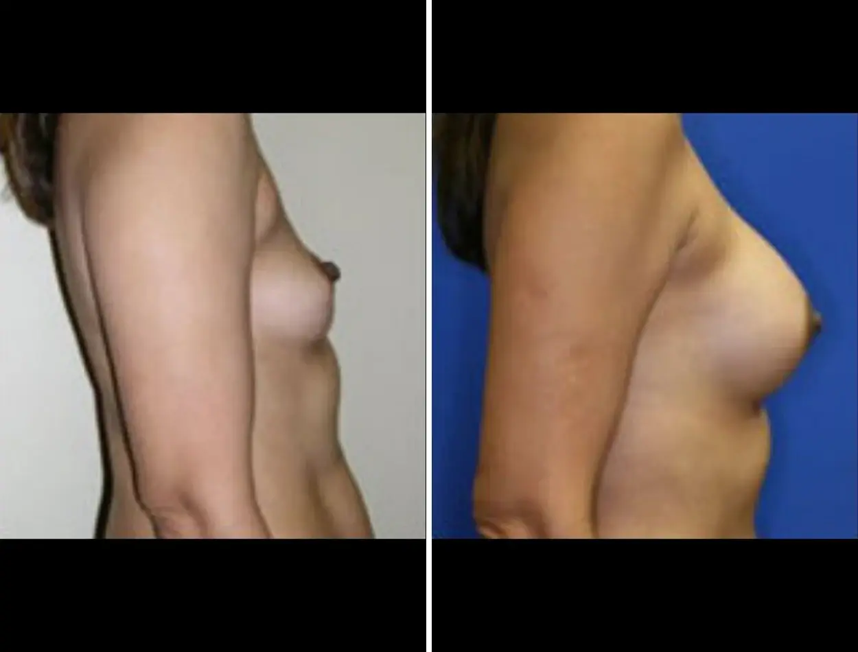 Miami Aesthetic breast augmentation result — Miami, FL