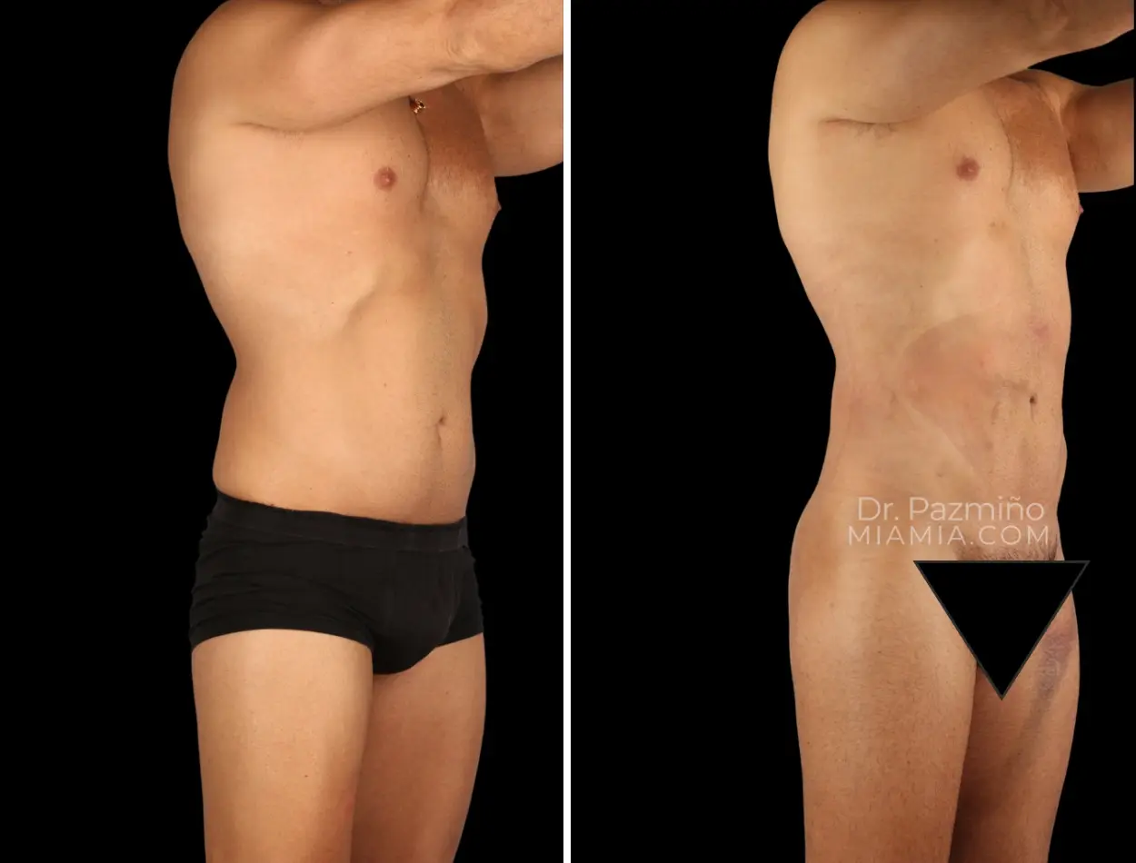 Miami Aesthetic body contouring result — Miami, FL