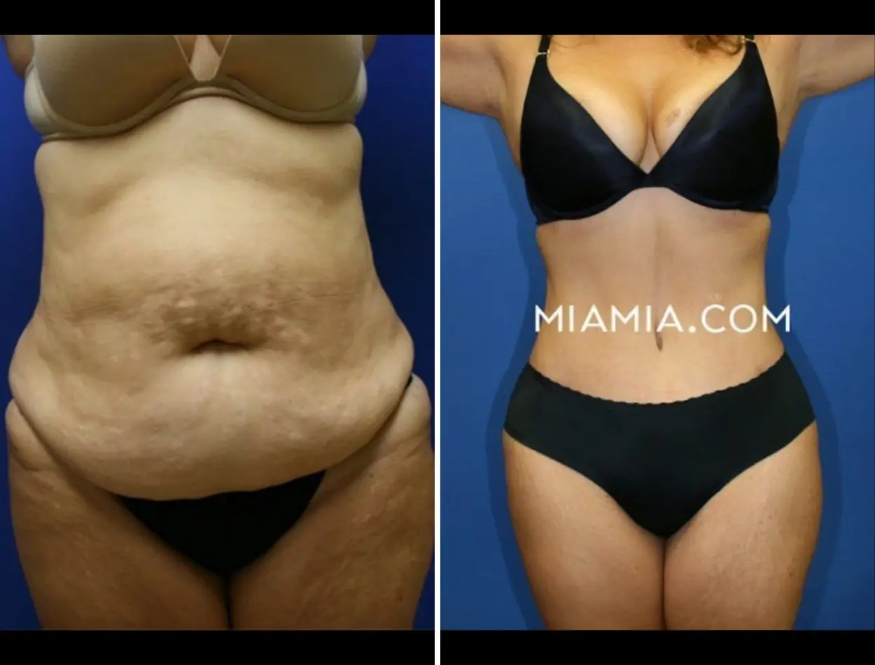 Miami Aesthetic tummy tuck result — Miami, FL