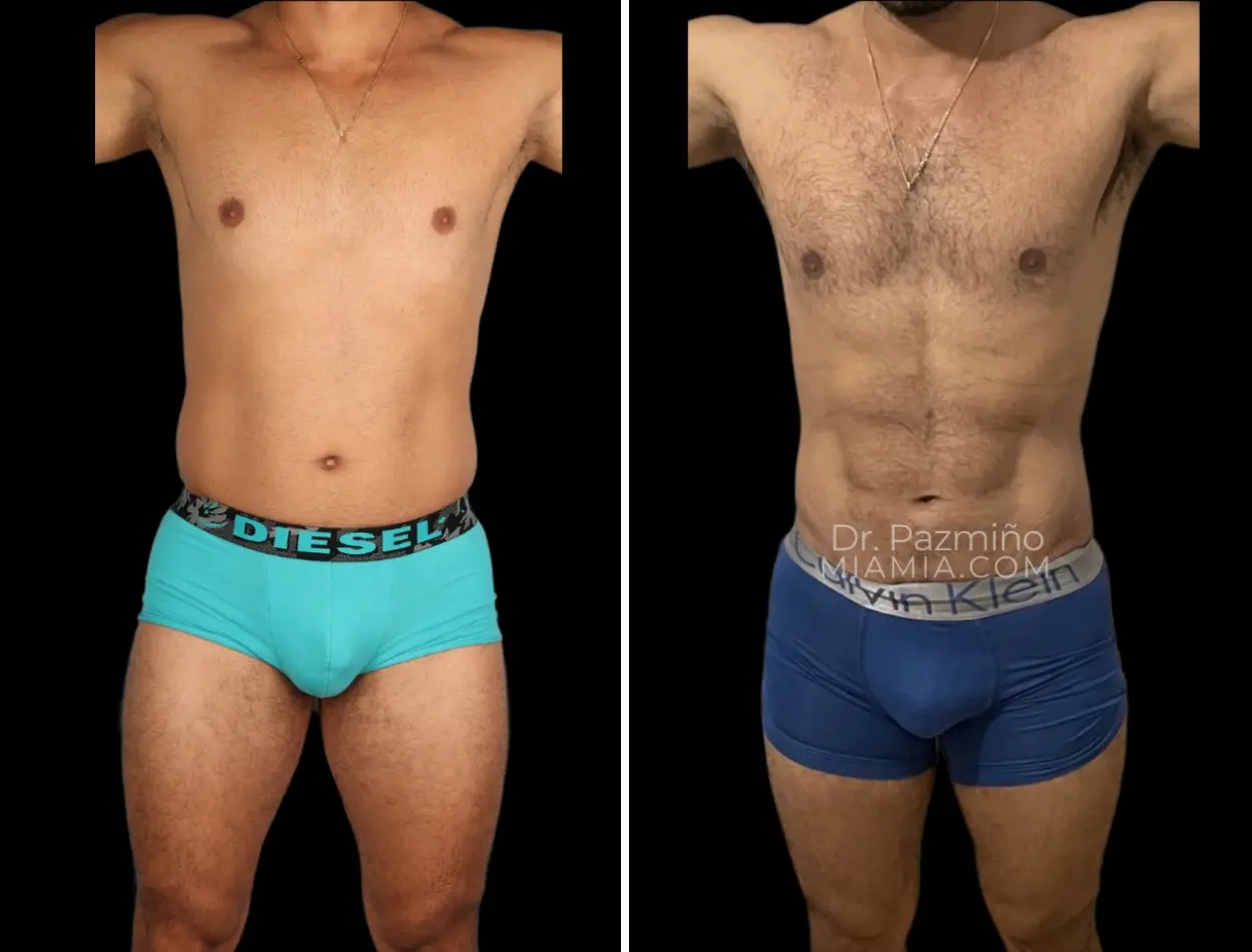 Miami Aesthetic body contouring result — Miami, FL