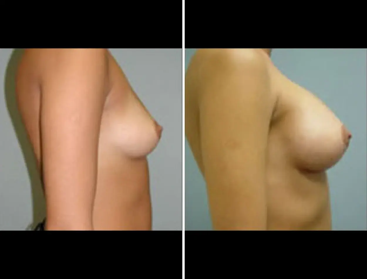 Miami Aesthetic breast augmentation result — Miami, FL