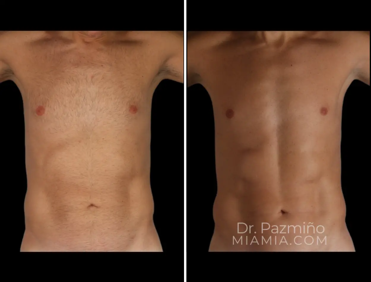Miami Aesthetic body contouring result — Miami, FL
