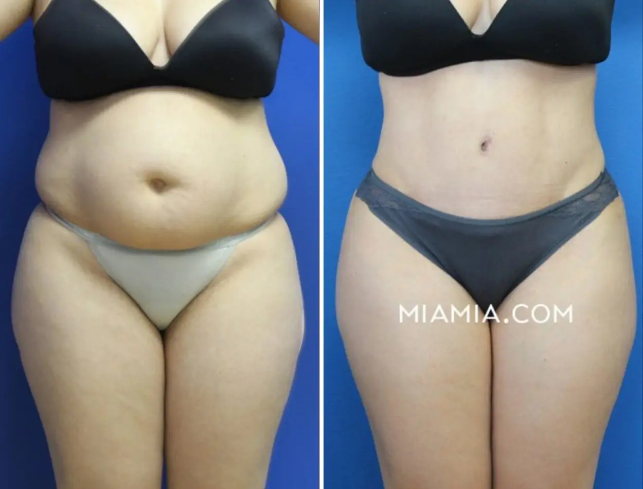 Miami Aesthetic tummy tuck result — Miami, FL