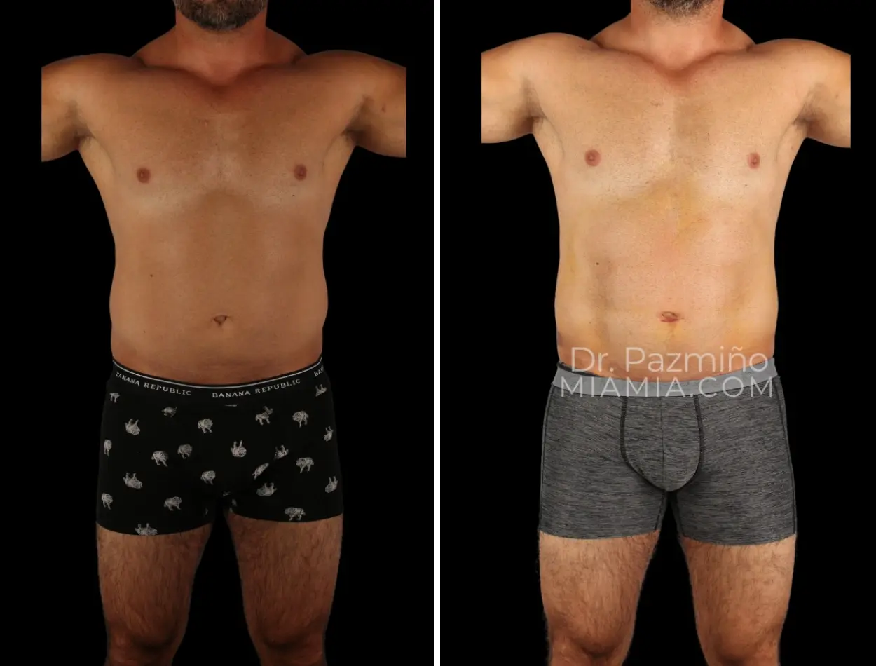 Miami Aesthetic body contouring result — Miami, FL