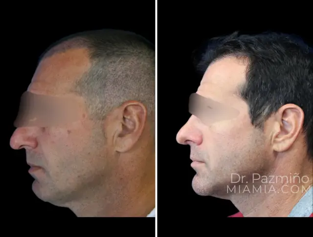 Facelift result at Miami Aesthetic in Miami, FL