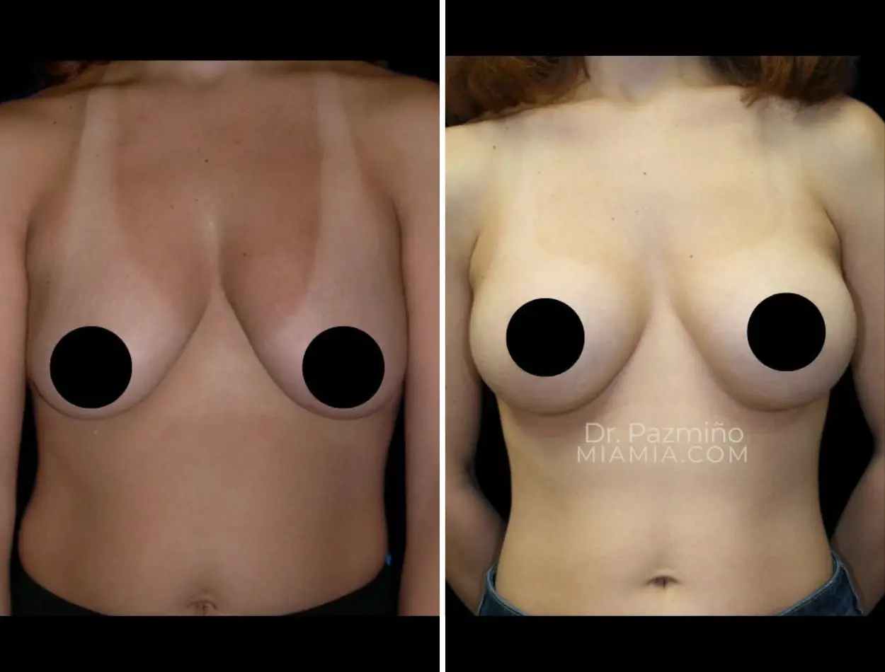 Miami Aesthetic breast augmentation result — Miami, FL