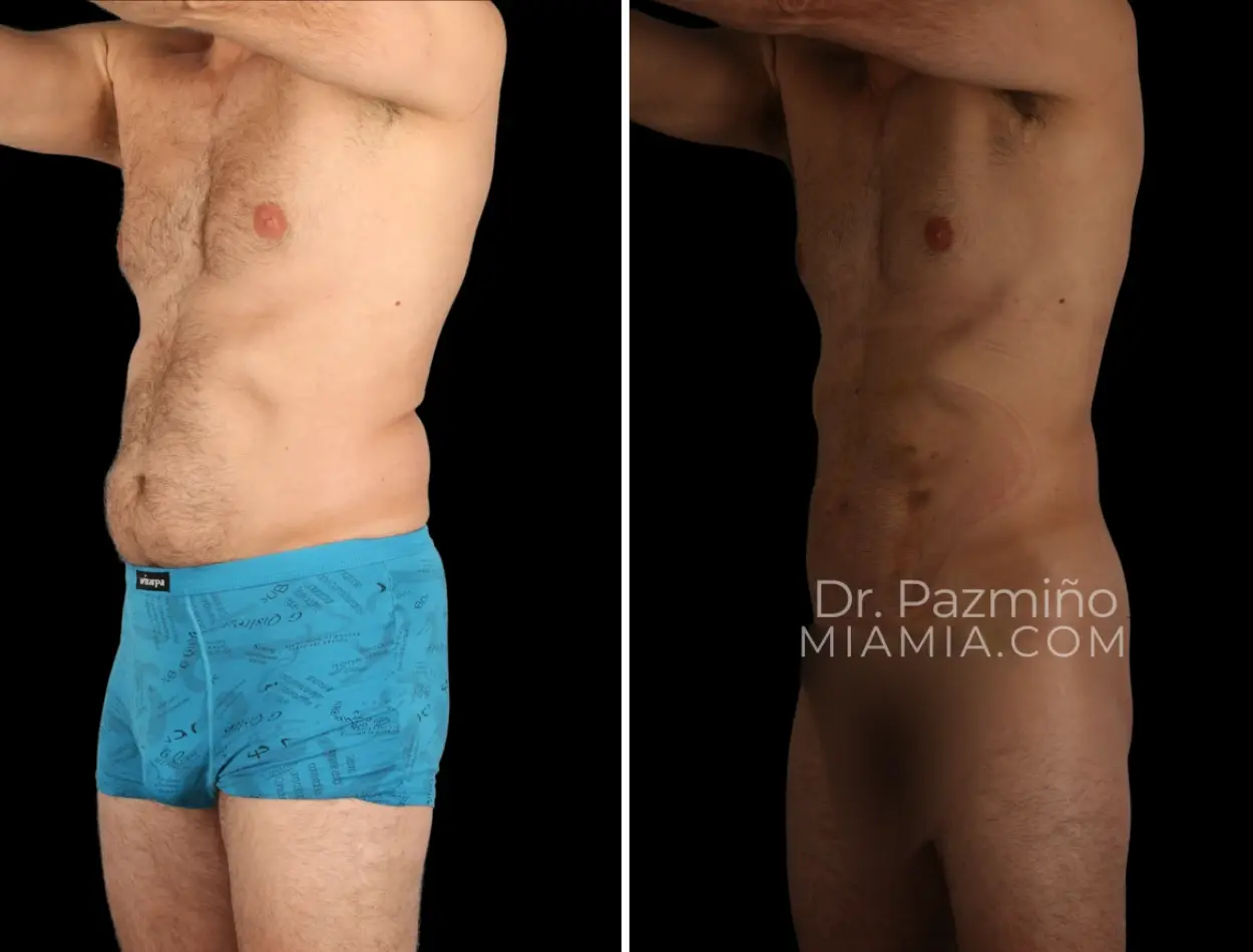 Miami Aesthetic body contouring result — Miami, FL