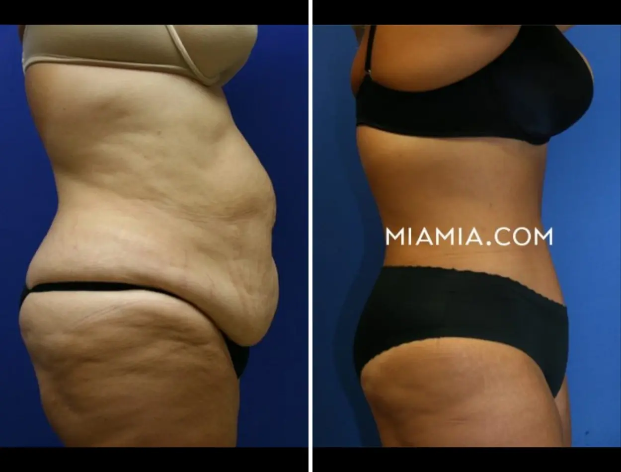 Miami Aesthetic tummy tuck result — Miami, FL
