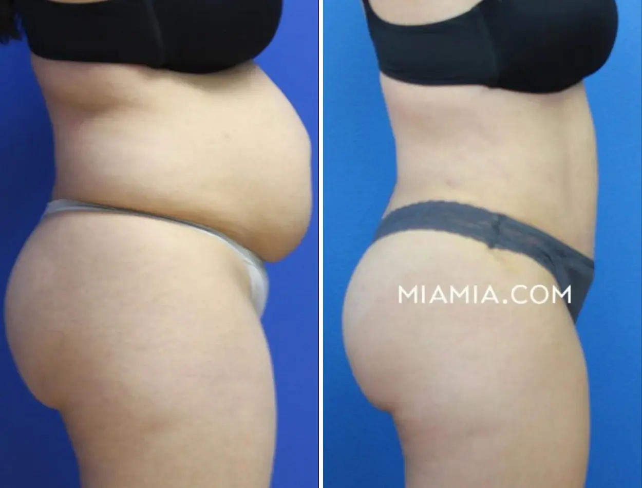 Miami Aesthetic tummy tuck result — Miami, FL