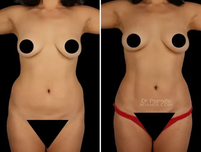 Liposuction result at Miami Aesthetic in Miami, FL