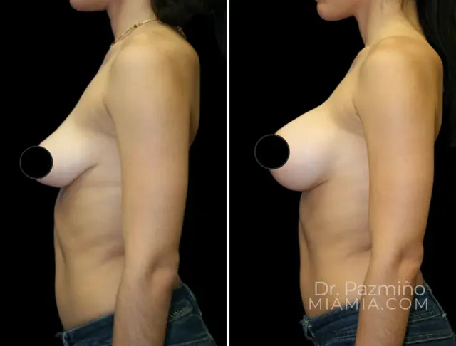 Breast Lift result at Miami Aesthetic in Miami, FL