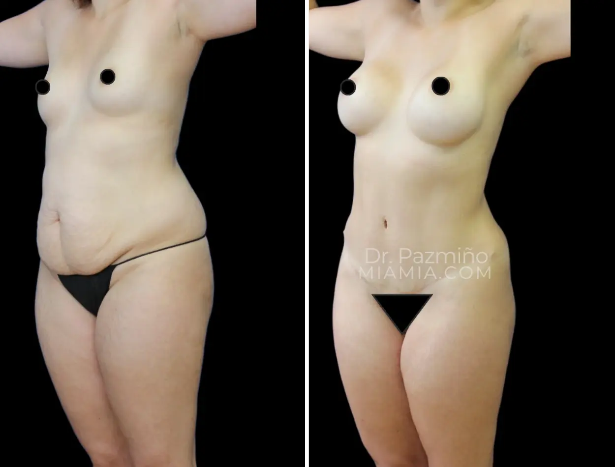 Miami Aesthetic tummy tuck result — Miami, FL