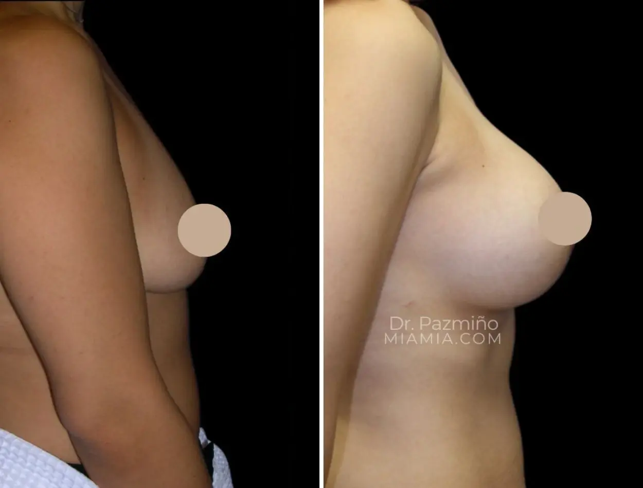 Miami Aesthetic breast augmentation result — Miami, FL