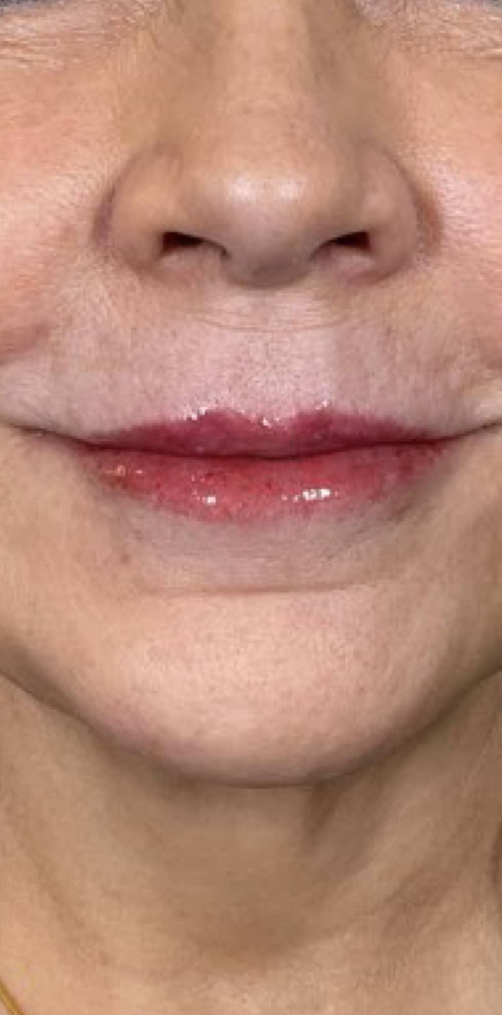 Aspen Dermatology lip filler after — Spanish Fork, UT