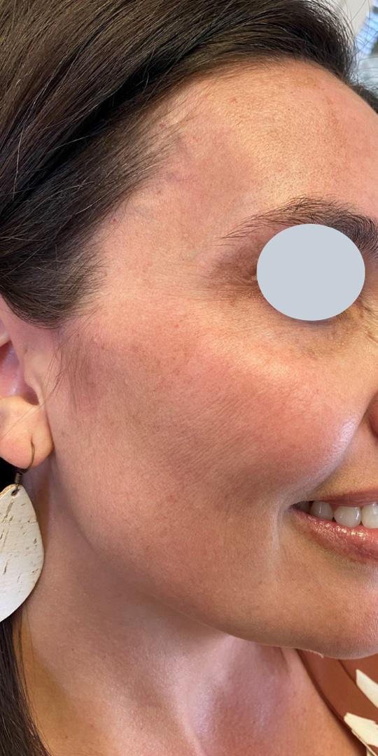 Aspen Dermatology after — Spanish Fork, UT