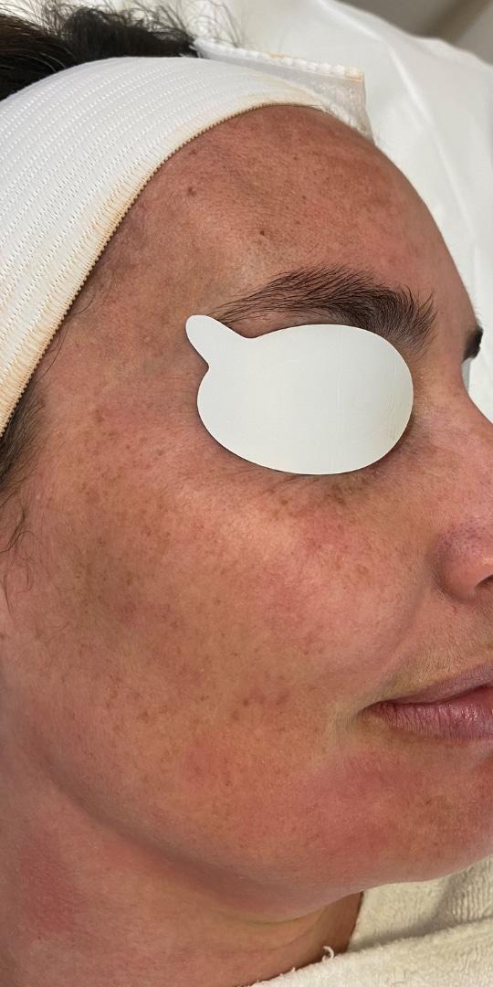 Laser Skin Resurfacing before at Aspen Dermatology in Spanish Fork, UT