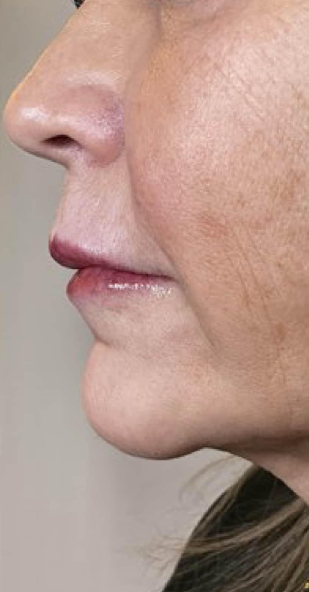 Aspen Dermatology lip filler after — Spanish Fork, UT