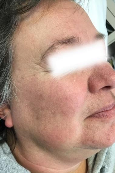 Aspen Dermatology laser treatment after — Spanish Fork, UT