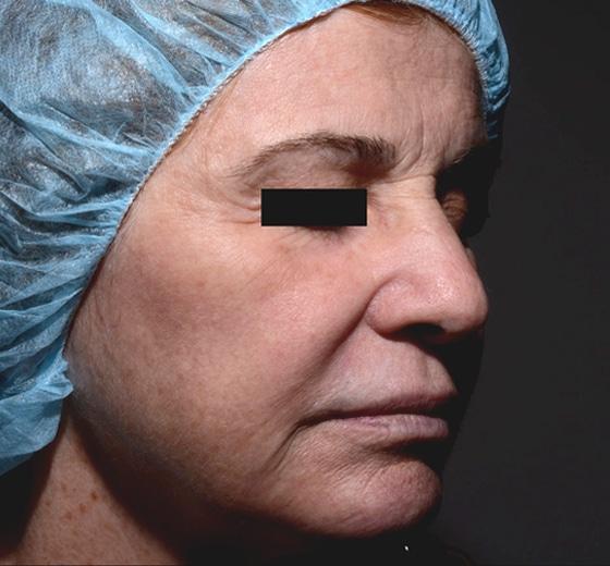 Aspen Dermatology after — Spanish Fork, UT