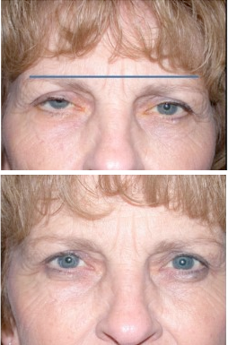 The Aesthetic Center at Virginia Eye Institute result — Henrico, VA