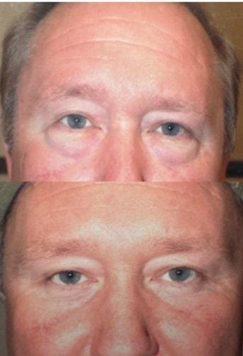 The Aesthetic Center at Virginia Eye Institute eyelid lift result — Henrico, VA