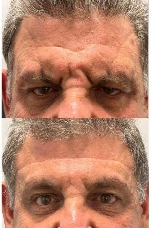 Brow Lift result at The Aesthetic Center at Virginia Eye Institute in Henrico, VA