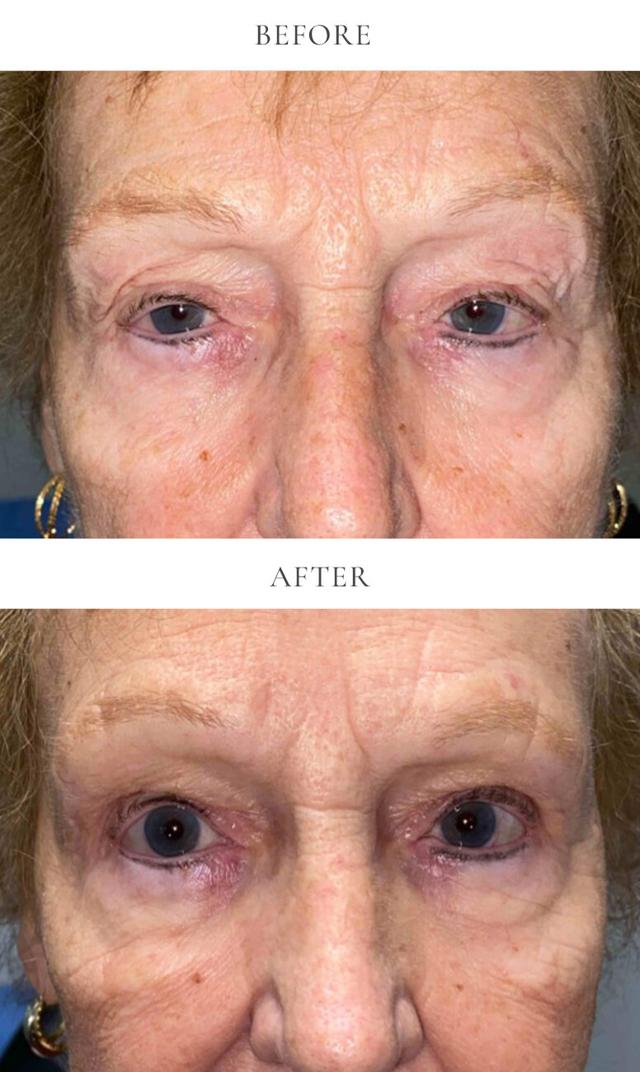 Blepharoplasty result at The Aesthetic Center at Virginia Eye Institute in Henrico, VA