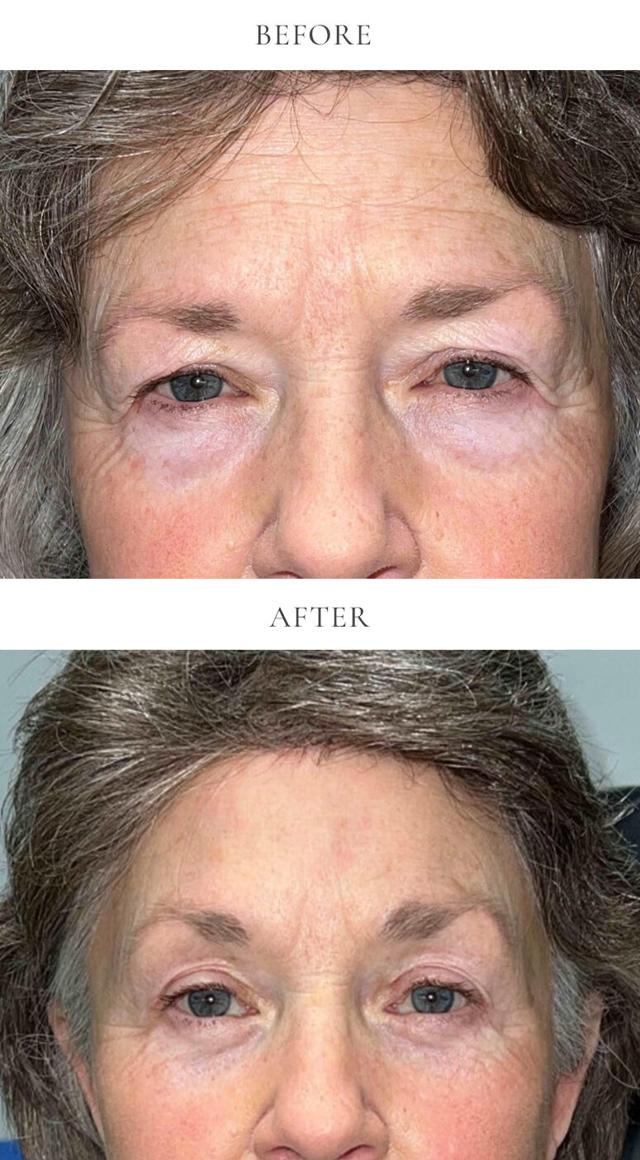 Blepharoplasty result at The Aesthetic Center at Virginia Eye Institute in Henrico, VA