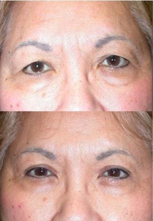 Blepharoplasty result at The Aesthetic Center at Virginia Eye Institute in Henrico, VA