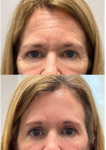 Brow Lift result at The Aesthetic Center at Virginia Eye Institute in Henrico, VA
