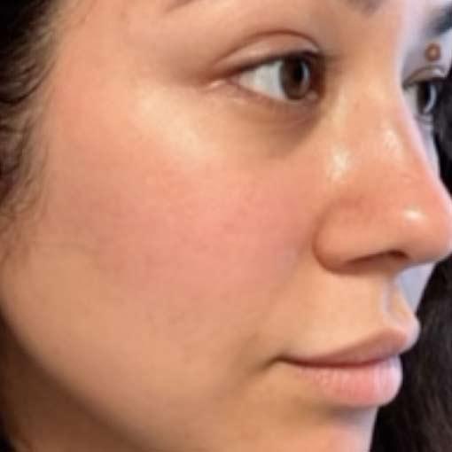 Rhinoplasty after at Ever/Body Hartford in West Hartford, CT