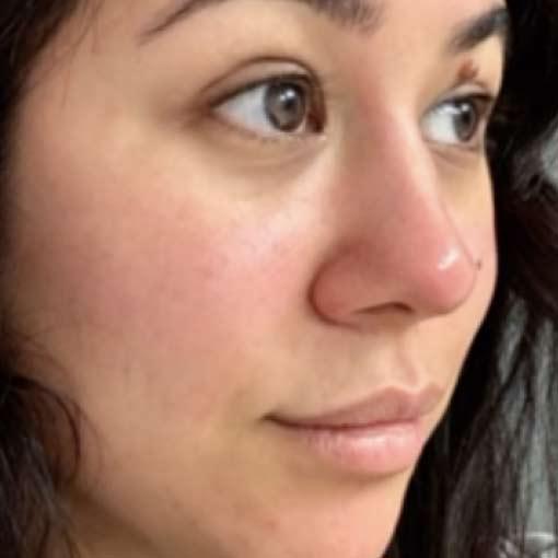 Rhinoplasty before at Ever/Body Hartford in West Hartford, CT