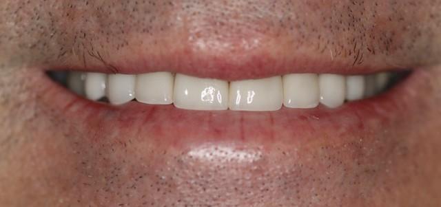 Douglas W. McMillan, DDS PLLC smile makeover after — Brentwood, TN