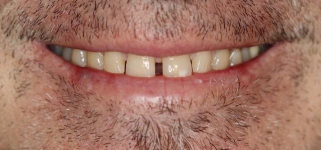 Smile Makeover before at Douglas W. McMillan, DDS PLLC in Brentwood, TN