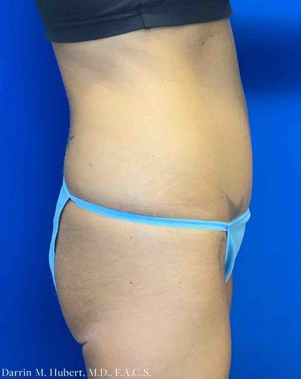 Dr. Darrin M. Hubert, MD tummy tuck after — Richmond, VA