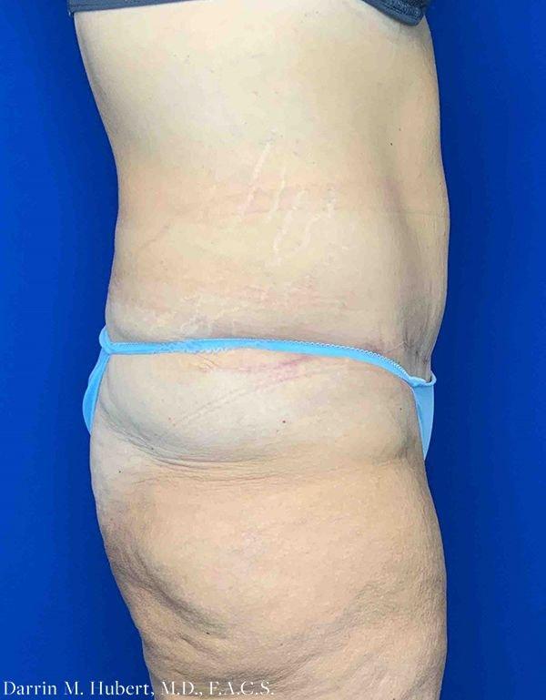 Dr. Darrin M. Hubert, MD tummy tuck after — Richmond, VA