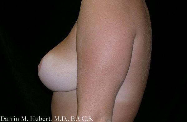 Breast Reduction after at Dr. Darrin M. Hubert, MD in Richmond, VA