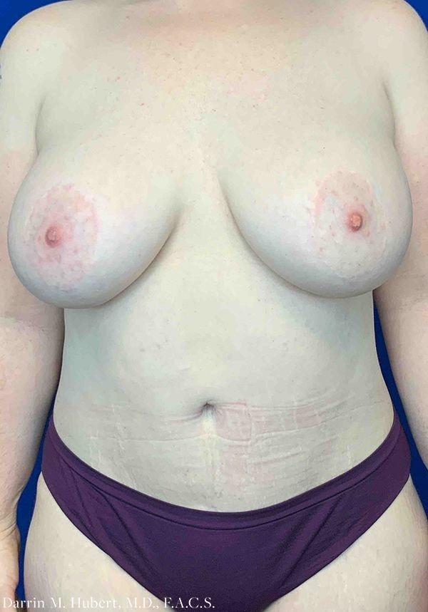 Mommy Makeover after at Dr. Darrin M. Hubert, MD in Richmond, VA