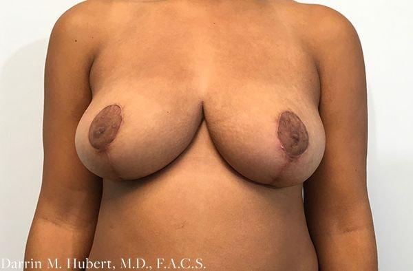 Breast Reduction after at Dr. Darrin M. Hubert, MD in Richmond, VA
