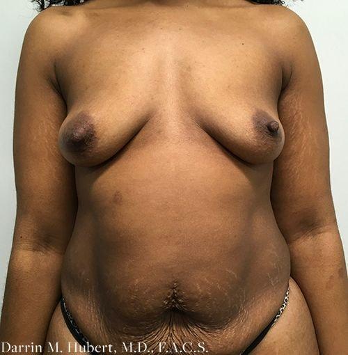 Mommy Makeover before at Dr. Darrin M. Hubert, MD in Richmond, VA