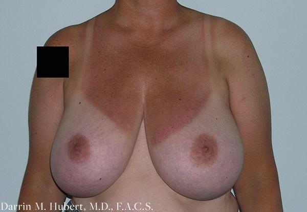 Breast Reduction before at Dr. Darrin M. Hubert, MD in Richmond, VA