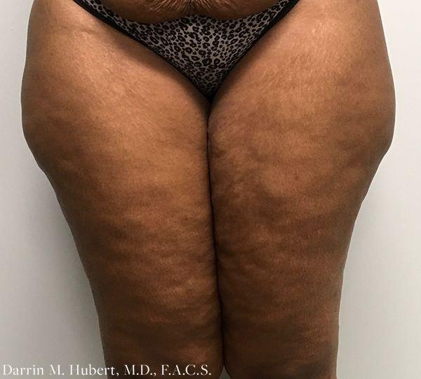 Liposuction before at Dr. Darrin M. Hubert, MD in Richmond, VA
