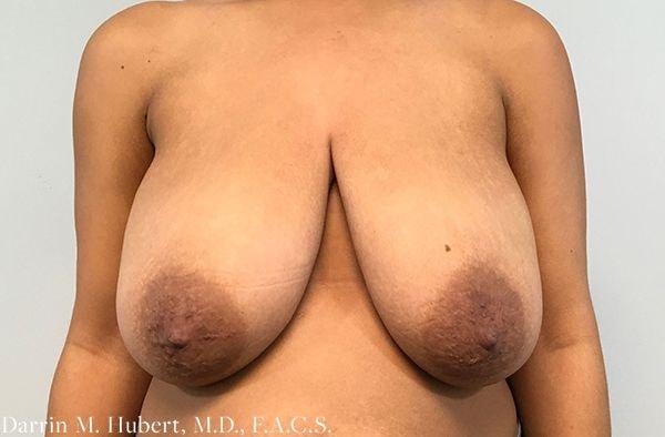 Breast Reduction before at Dr. Darrin M. Hubert, MD in Richmond, VA