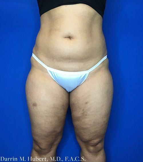 Liposuction before at Dr. Darrin M. Hubert, MD in Richmond, VA