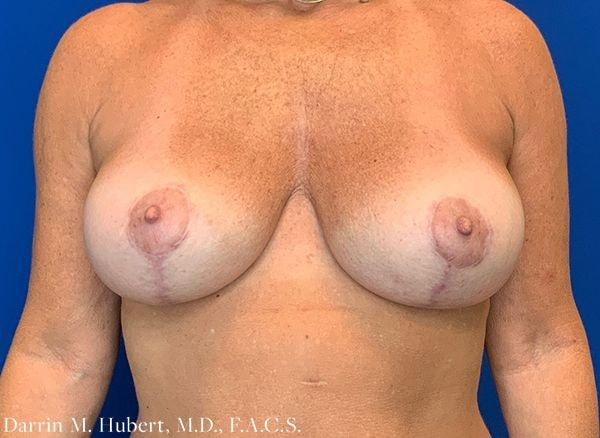 Breast Lift after at Dr. Darrin M. Hubert, MD in Richmond, VA