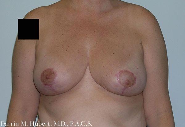Breast Reduction after at Dr. Darrin M. Hubert, MD in Richmond, VA
